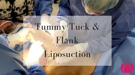 Read more about Pain after liposuction flanks. . Uneven flanks after tummy tuck